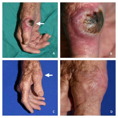Cureus Resolution Of Keratoacanthoma Type Squamous Cell Carcinoma