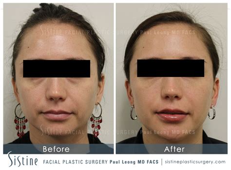 Dermal Fillers Before And After 03 Sistine Facial Plastic Surgery