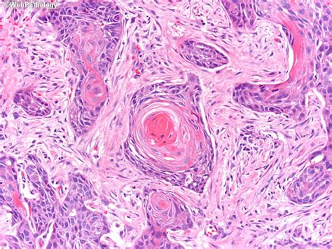 A concretion formed around a grain of sand or other foreign body within the shell of certain mollusks. Webpathology.com: A Collection of Surgical Pathology Images