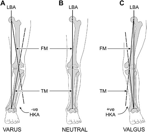 Static Knee Alignment And Its Association With Radiographic Knee