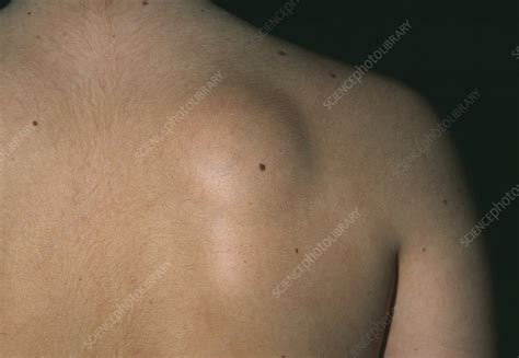 Lipoma Swelling Stock Image M2000182 Science Photo Library