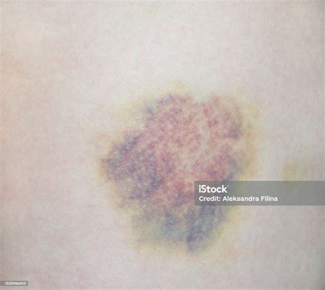 Close Up Of A Hematoma On The Leg Skin Stock Photo Download Image Now