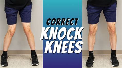 Top 5 Ways To Correct Knock Knees With Exercise Etc Knock Knees