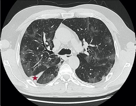 Covid 19 In A Patient Treated For Granulomatosis With Polyangiitis