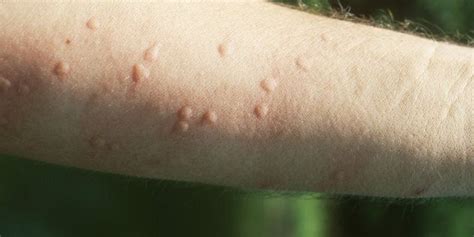 Hives often occur as an allergic reaction to something eaten or ingested or something that has contacted the skin. What Are Heat Hives And How Do You Get Rid Of Them ...