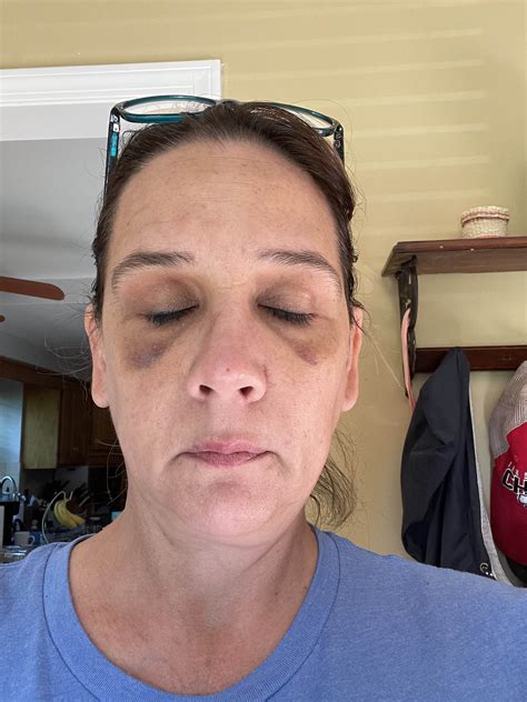 photos show battered face of missouri mom viciously attacked by teen girls