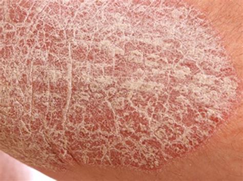 Dry Skin On Legs Pictures Extremely Dry Skin Between Legs Look Likes
