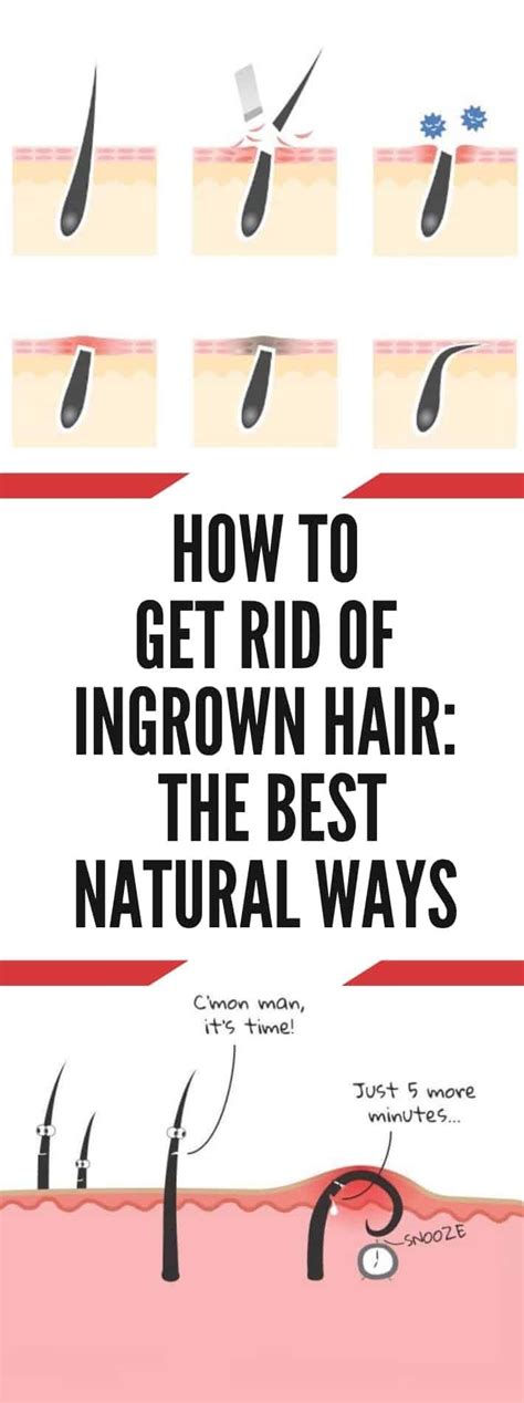 How To Get Rid Of Ingrown Hair The Best Natural Ways Ingrownhairthigh