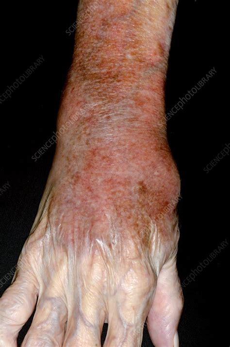 Cellulitis Of The Wrist Stock Image C0167233 Science Photo Library