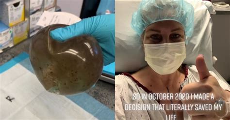 Жена откри мухъл в гръдните си импланти СНИМКА Zdraveto