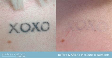 Picosure® Tattoo Removal Uk Andrea Catton Laser Clinic Burnley