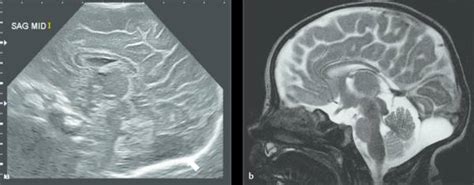 3 Neonatal Cranial Ultrasonography Radiology Key