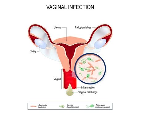 Vaginitis Patofisiologi Diagnosis Penatalaksanaan Alomedika The Best Porn Website