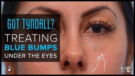 Got Tyndall Treating Blue Bumps Under The Eyes Youtube