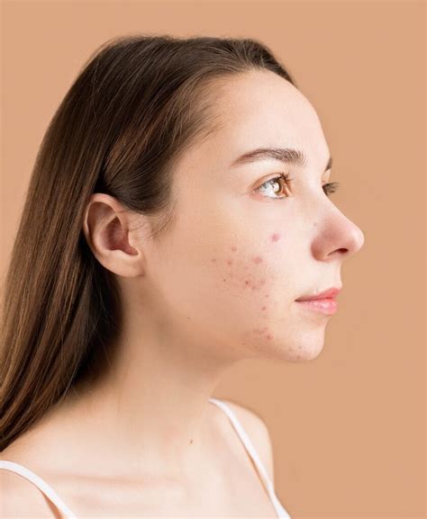Managing Acne As An Adult Swinyer Woseth Dermatology