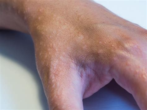 What Is Dyshidrotic Eczema How To Identify And Treat Eczema Blisters