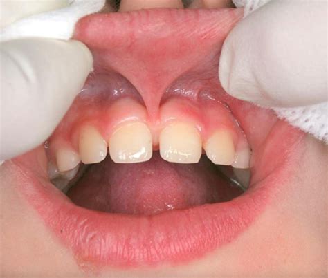 Tongue And Lip Frenulectomy