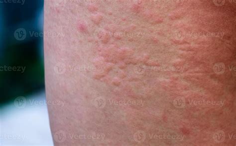 Forte Allergico Eruzioni Cutanee Su Il Corpo Alterata Immunità E