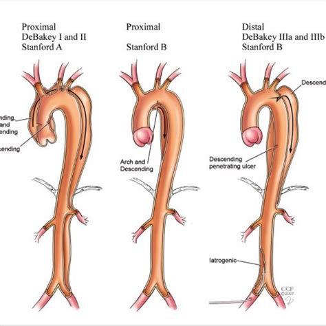 Dacron Graft Repair Of Ascending And Descending Aortic Dissection