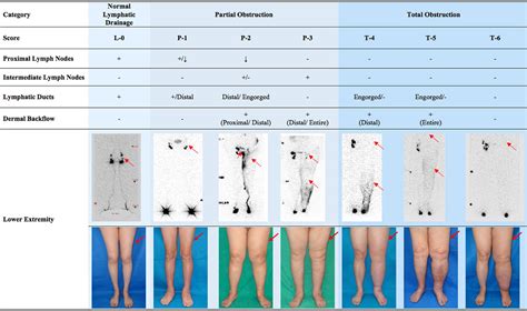 Cheng Lymphedema Grading System Moderate To Severe Cases Ming Huei