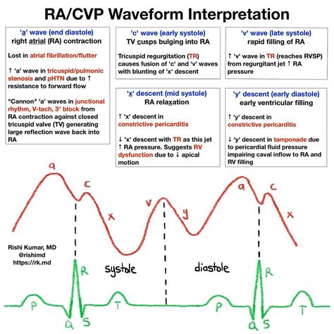 Cvp Waveform Atrial Fibrillation