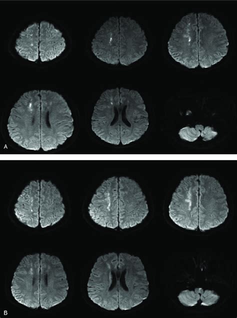 Mri Indicated A Hyper Intense Dwi Signals Of The Central Lesion In