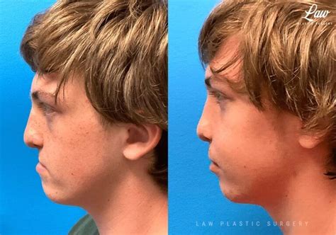Facial Fat Grafting Before And After Photos Law Plastic Surgery