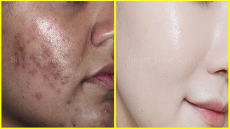 Dark Spots On Skin Fade Dark Spots In A Week Diy Turmeric Face Mask