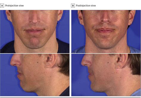 Modification Of Chin Projection And Aesthetics With Onabotulinumtoxina Injection Semantic Scholar
