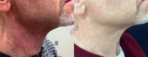 Pulsed Dye Laser Before And After Photo Gallery Dallas Plano And