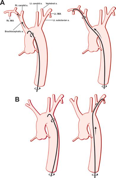 Temporary Transvenous Pacemaker Placement Thoracic Key