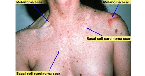 Xeroderma pigmentosum, which is commonly known as xp, is an inherited condition characterized by an extreme sensitivity to ultraviolet (uv) rays from sunlight. Xeroderma Pigmentosum - www.medicoapps.org
