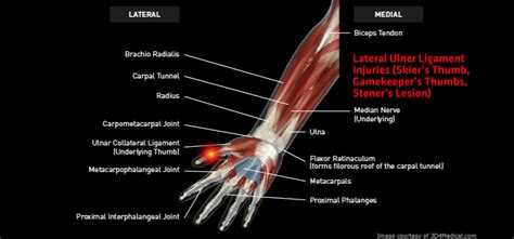 Lateral Ulner Ligament Injuries Skiers Thumb Gamekeeper