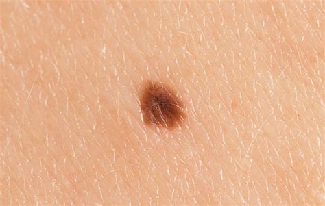 5 Signs Of Skin Cancer That Are Easy To Overlook Bicycling