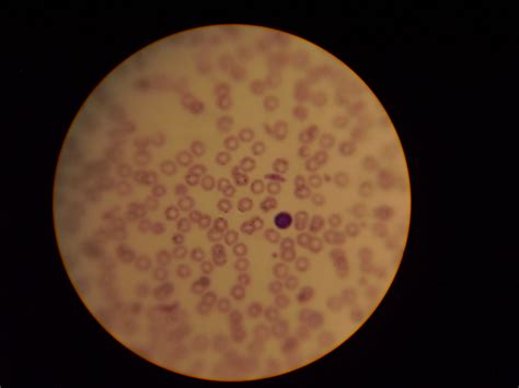 Plasmodium Falciforme Gametociti Doccheck