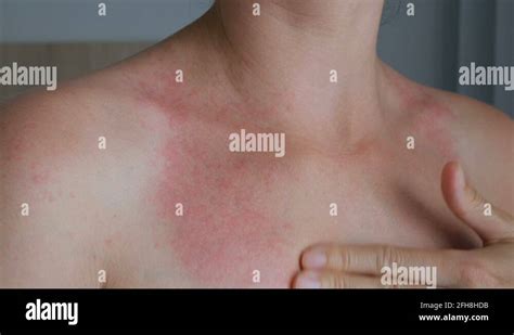 Woman Scratch The Itch With Hand Neck Red Spots On The Neck