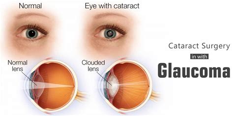 Cataract Surgery In Eyes With Glaucoma Contoura Vision India
