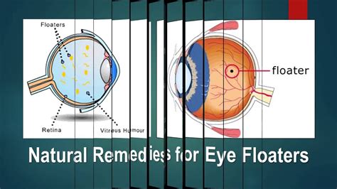 Natural Remedies For Eye Floaters Youtube