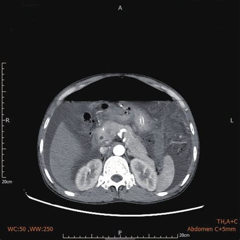 Contrast Enhanced Abdominal Computed Tomography Before The First