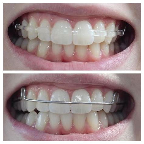 Art Orthodontic Laboratory Dental Braces Teeth Straightening Teeth