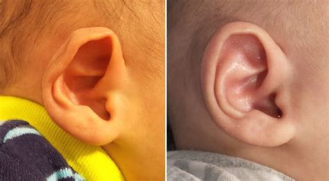 Ear Molding Jandali Plastic Surgery Shareef Jandali Md