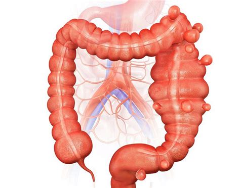 Doença Diverticular Dos Cólons Sintomas