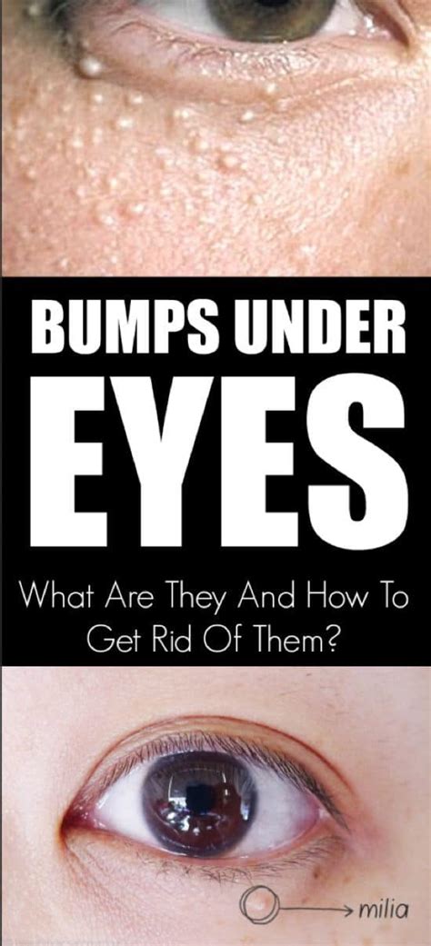 Bumps Under Eyes What Are They And How To Get Rid Of Them