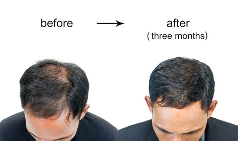 How To Reverse Hair Loss Home Design Ideas