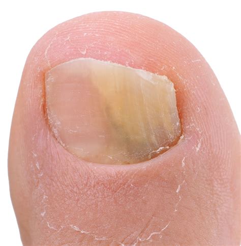 Thick Discolored Nail Is It A Fungus Center Grove Foot And Ankle Care