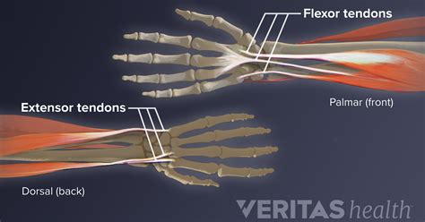 Wrist Tendonitis An Overview