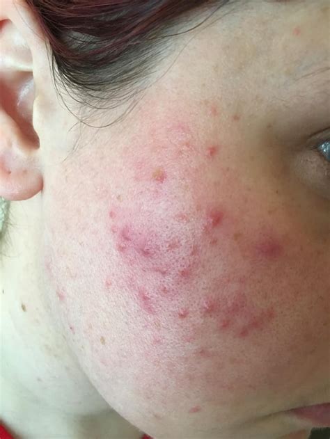 Skin Concerns Moved Country And Suddenly Right Cheek Acne R