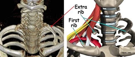 In this article, we are going to study the brachial plexus in detail. Numbness in your arms and hands? - Revolution Health Centre