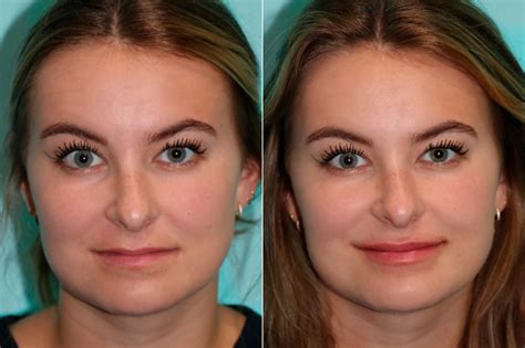 Lip Augmentation Photos Chevy Chase Md Patient 17093
