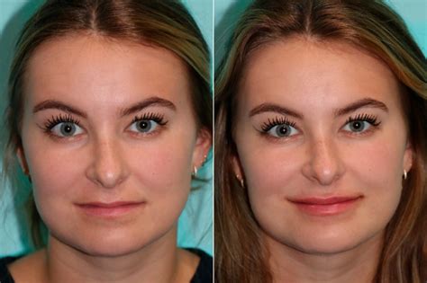 Lip filler aftercare tip #4: Lip Augmentation before and after photos - Page 4 of 4 ...